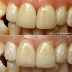 Before and After Treatments | Luth And Heideman Center