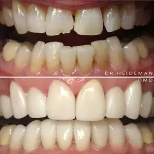 Before and After Treatments | Luth And Heideman Center
