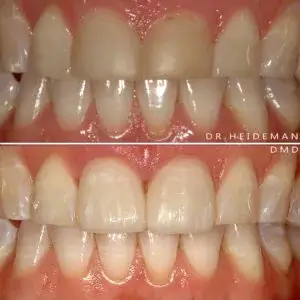 Before and After Treatments | Teeth Whitening | Luth And Heideman Center