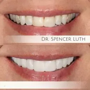Before and After Treatments | Teeth Whitening | Luth And Heideman Center