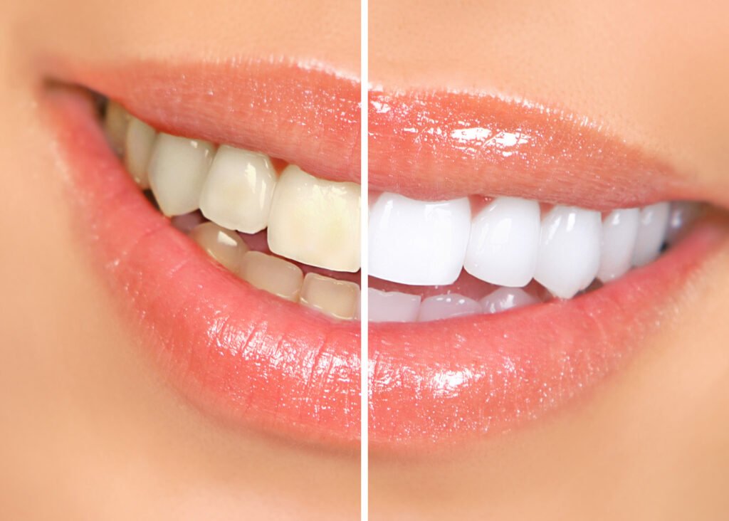 Teeth Whitening Treatment |