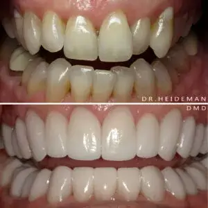 Before And After Photos | Teeth Whitening in Las Vegas, NA