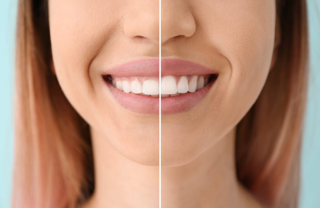 What to Expect During a Gum Shaping Treatment A Step-by-Step Guide To The Procedure And Recovery