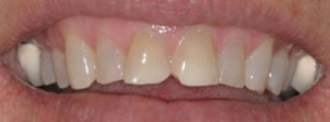 Patient teeth before picture