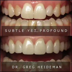 Before and After Veneers | Luth And Heideman Center