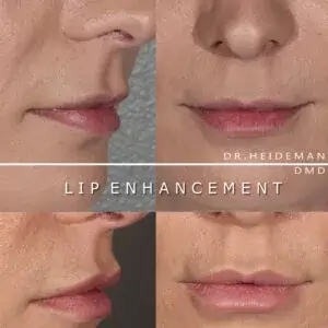 Lip Filler | Luth And Heideman Center