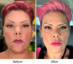Before and After Treatment in Las Vegas NV | Luth And Heideman Center