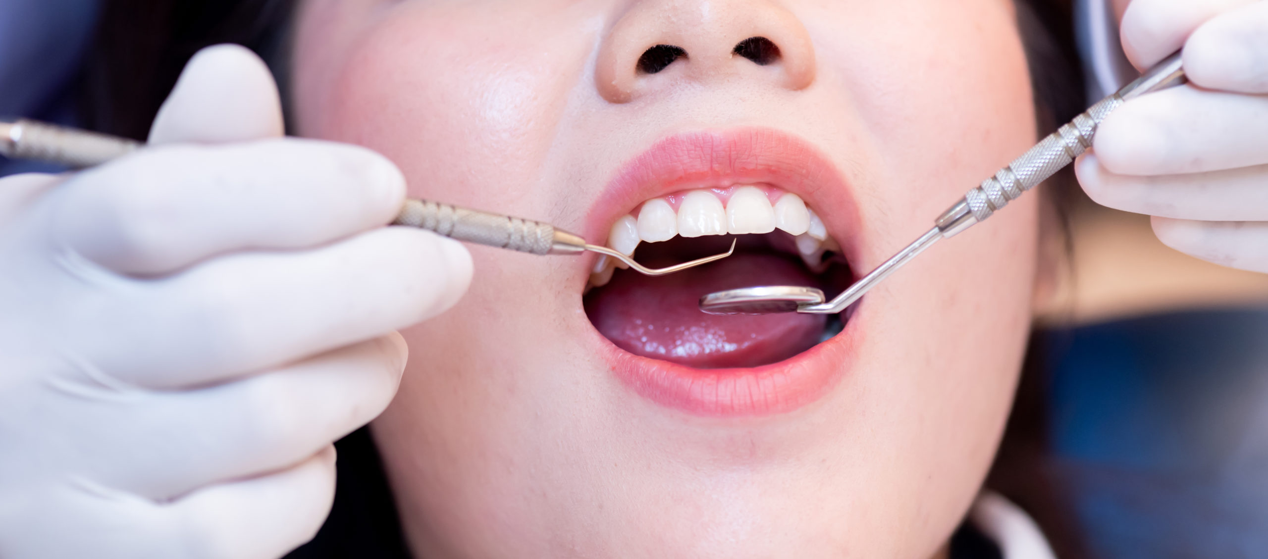 What Are The Steps Of A Full Mouth Reconstruction?