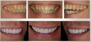 Before and After Teeth Cleaning | Luth And Heideman Center